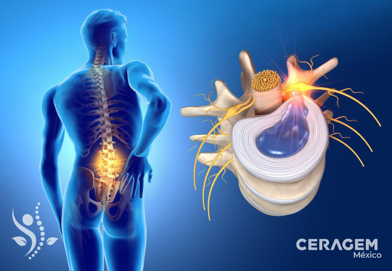 Qué es una hernia discal